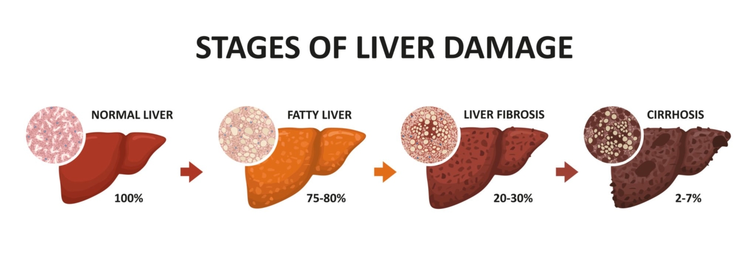 Liv Pure: The Benefits for Improved Liver Enzyme Levels
